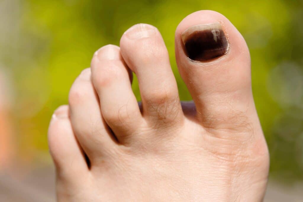 Can I Hike with a Missing Toenail?